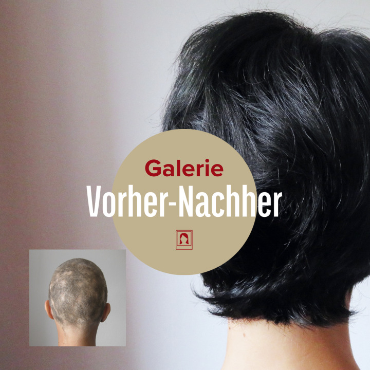 Vorher-nachher Galerie: Haarausfall gestoppt