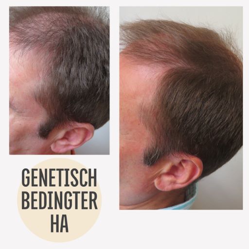 Vorher Nachher Haarausfall Mann genetisch bedingter Haarausfall