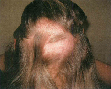 Ayurveda Fallstudie kreisrunder Haarausfall junge Frau vorher-nachher Kaya Veda