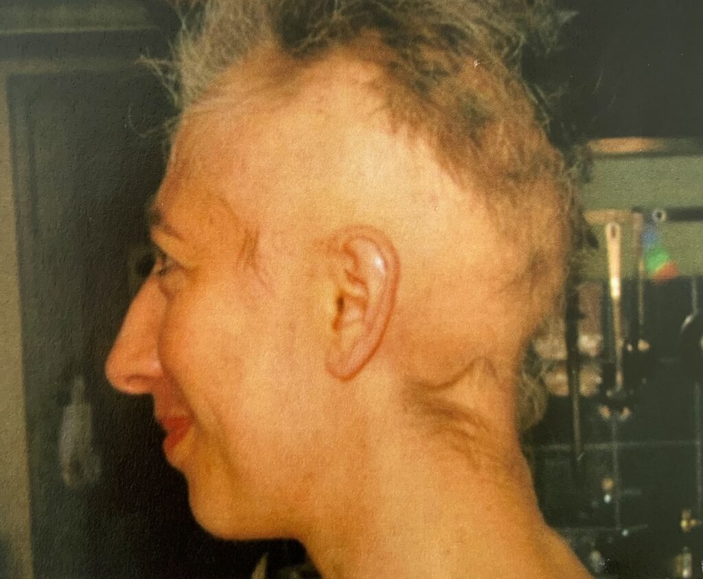 Fallstudie 90 Prozent Haarverlust nach Tod des Vaters