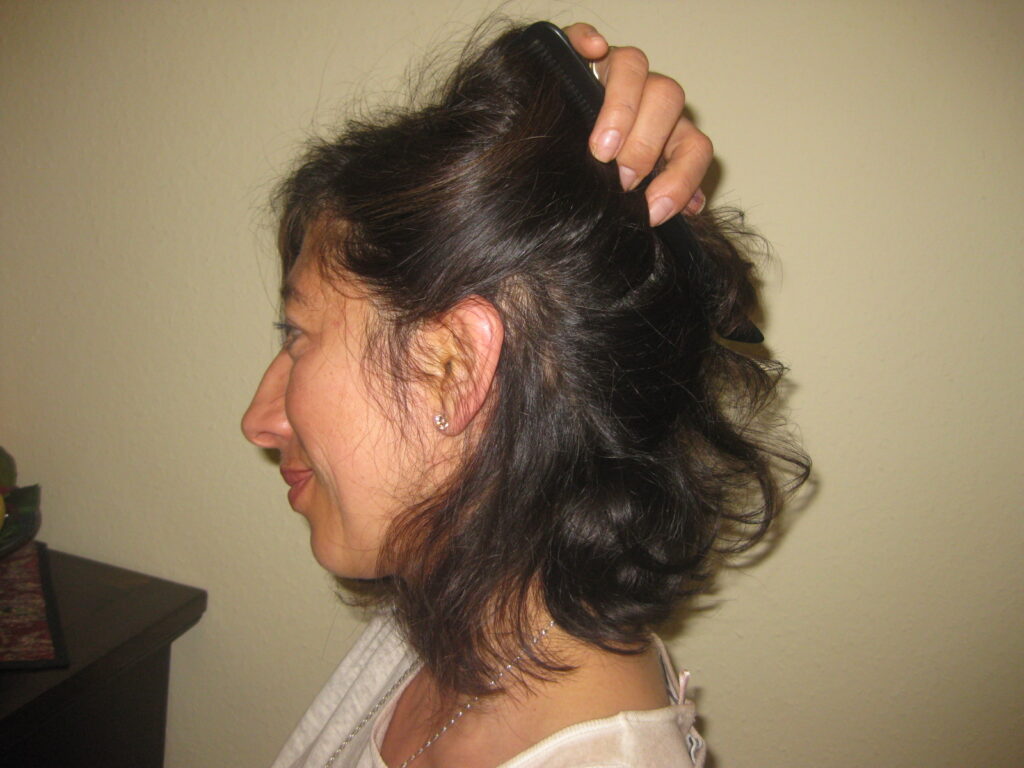 Ein Jahr nach 90 Prozent Haarverlust wieder volles Haar