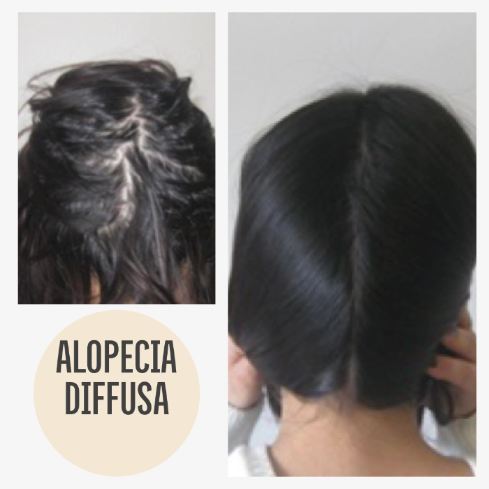 Echte Klientenbilder vorher nachher Haarausfall KAYA VEDA Ayurveda