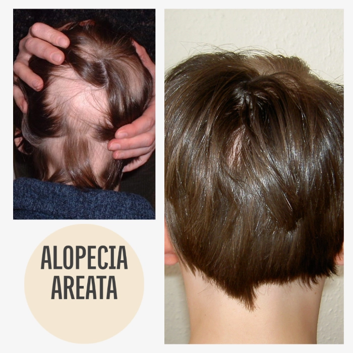 Echte vorher-nachher Bilder kreisrunder Haarausfall Kind mit KAYA VEDA Ayurveda