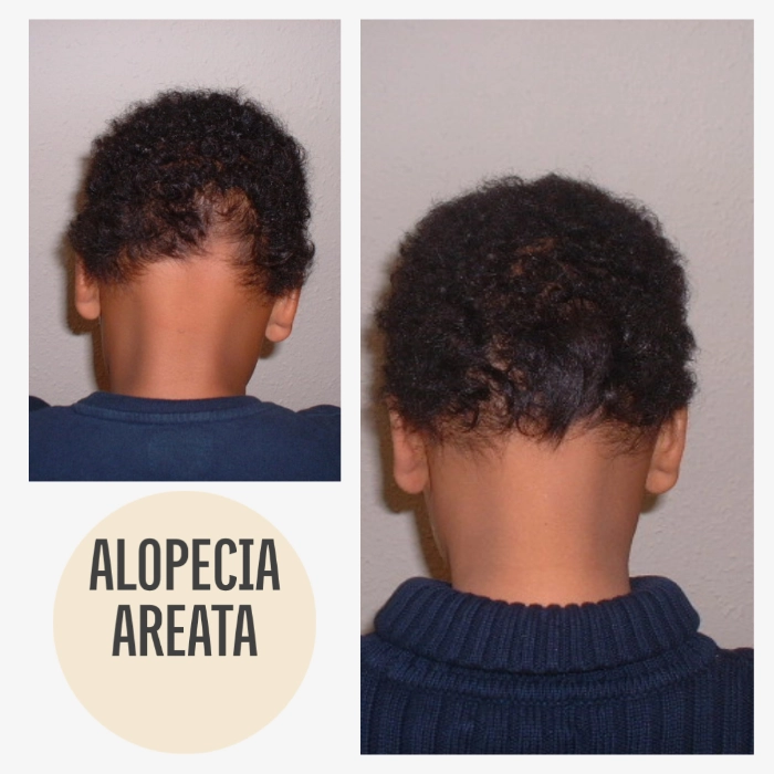 Echte vorher-nachher Bilder kreisrunder Haarausfall Kind mit KAYA VEDA Ayurveda