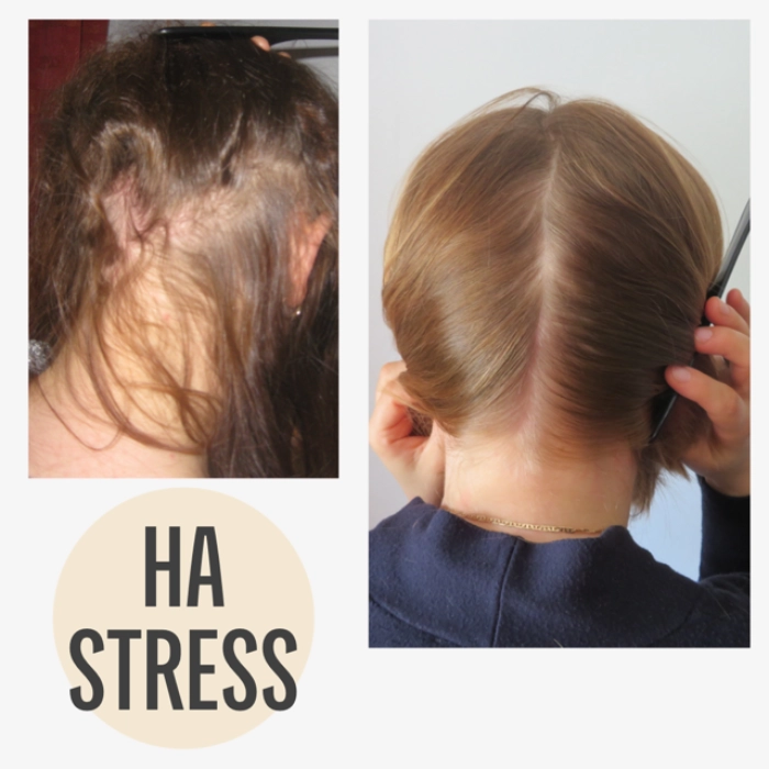 Vorher Nachher Haarausfall mit KAYA VEDA Ayurveda