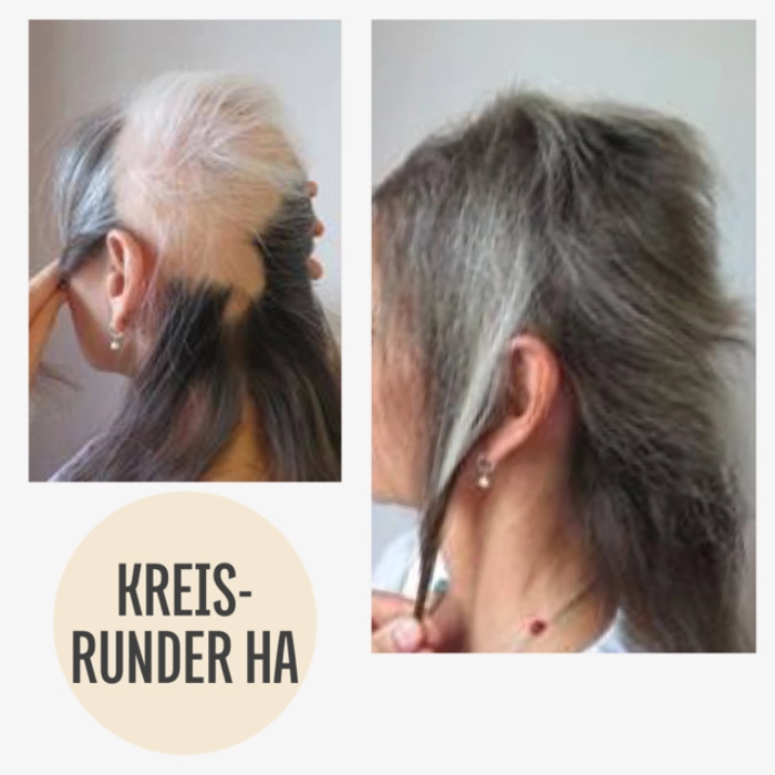Vorher Nachher Haarausfall mit KAYA VEDA Ayurveda