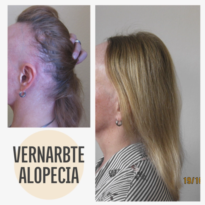 Vorher Nachher Haarausfall mit KAYA VEDA Ayurveda