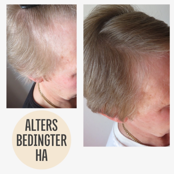 Vorher Nachher Haarausfall mit KAYA VEDA Ayurveda