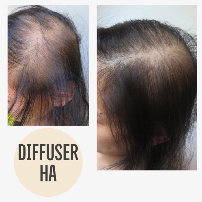 Vorher Nachher Haarausfall mit KAYA VEDA Ayurveda