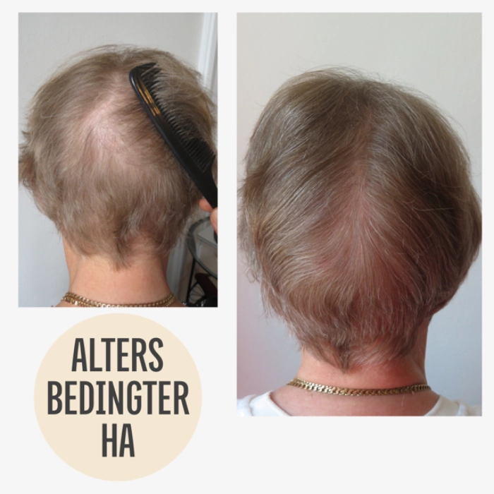 Vorher Nachher Haarausfall mit KAYA VEDA Ayurveda