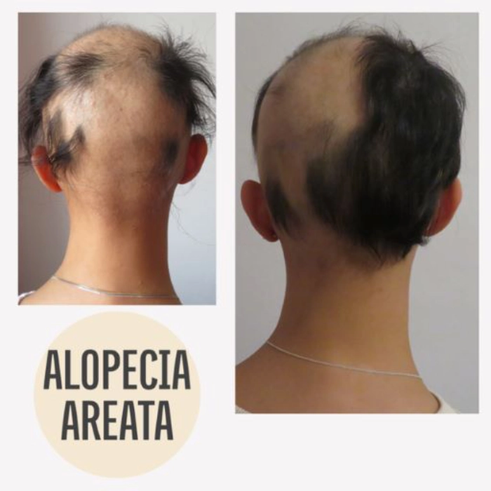 Echtes vorher-nachher Bild von kreisrunder Haarausfall Klient KAYA VEDA Ayurveda