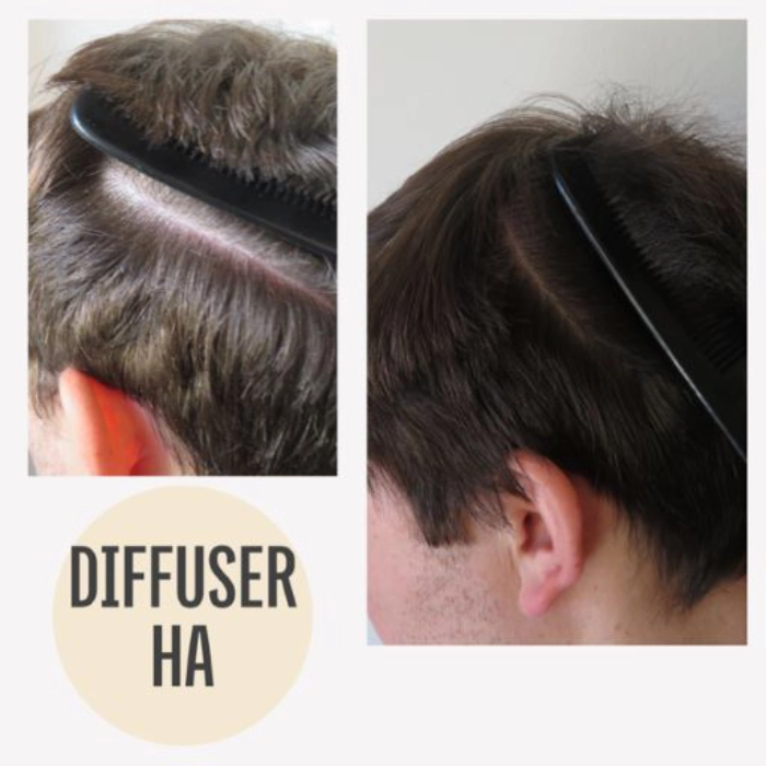 Echtes Vorher-Nachher-Bild Mann mit diffusem Haarausfall nach Behandlung bei KAYA VEDA Ayurveda