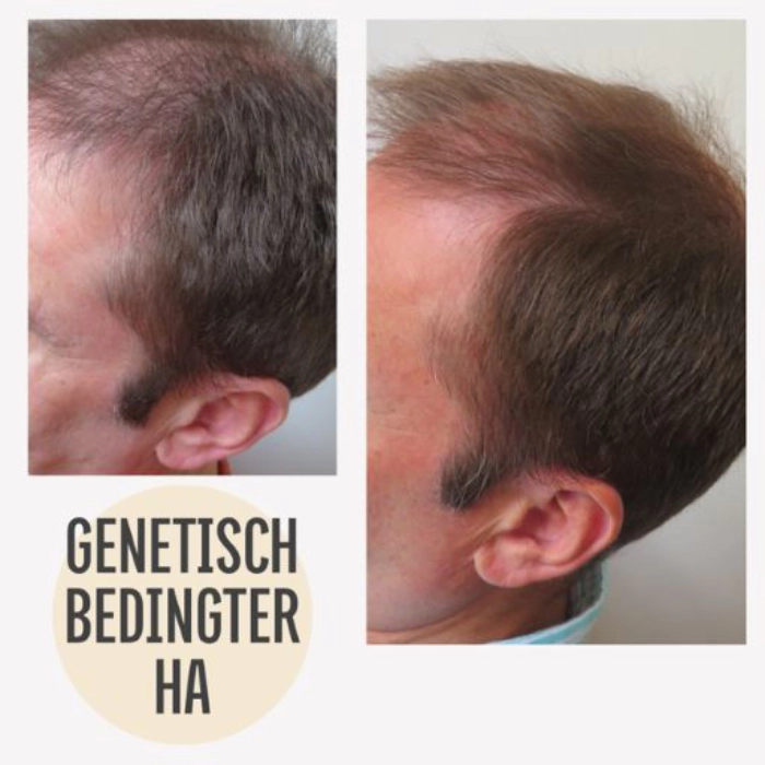 Echtes vorher-nachher Bild genetisch bedingter Haarausfall Mann | KAYA VEDA Ayurveda